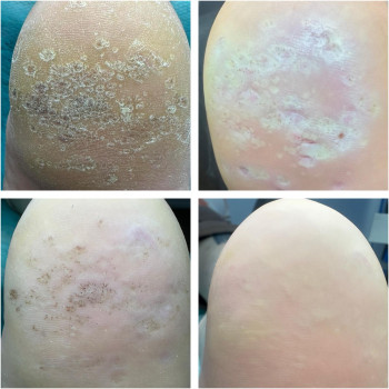 до/після (6 сеансів)