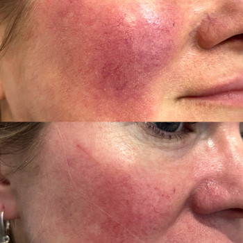 Результат лікування розацеа ( судин) одразу після процедури