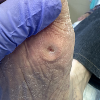 Мозоли нужно удалить, потому что они могут приводить
до боли, осложнений и проблем с походкой