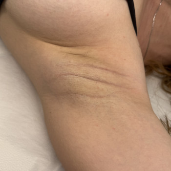 Проміжний результати електроепіляції