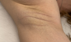 Електроепіляція Мастер восковой депиляции  Черновцы