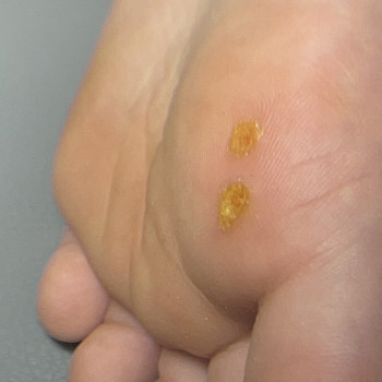 На фото — підошовні бородавки у дитини.
Дві невеликі бородавки були розташовані поруч, через що створювали дискомфорт і біль при ходьбі.

Обробка проводилась поетапно, максимально щадно, з урахуванням дитячої шкіри.
Без агресивних методів і без травмування здорових тканин.

👉 Результат:
Бородавка повністю видалилась після двох обробок.
Шкіра відновилась, біль зник, дитина знову може нормально наступати на стопу.
 #подологмукачево #обробкабородавокмукачево #лікуваннябородавокмукачево