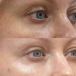 Мезотерапія для повік Дерматолог косметолог Нелли Киев