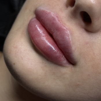 збільшення губ, контурна пластика губ, увелечениегуб