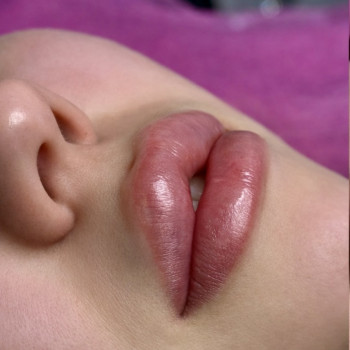 збільшення губ, контурна пластіка губ, губи