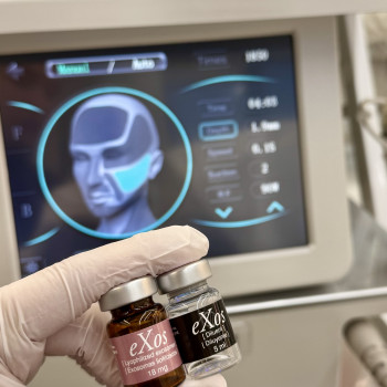 Мікроголковий RF-ліфтинг з екзосомами — це комбінована апаратна процедура, яка поєднує дію мікроголок, радіочастотної енергії та екзосом для покращення якості шкіри та прискорення процесів відновлення. Під час процедури створюються контрольовані мікропроколи, через які активні компоненти екзосом проникають у глибші шари шкіри, а RF-енергія стимулює синтез колагену та еластину.

Процедура підходить для пацієнтів із втратою пружності та щільності шкіри, нерівним рельєфом та розширеними порами.