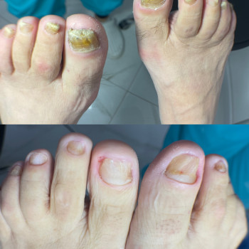 Оніхогрифоз — деформований товстий ніготь+грибкове ураження.Професійна допомога подолога.
 #грибокнігтямукачево