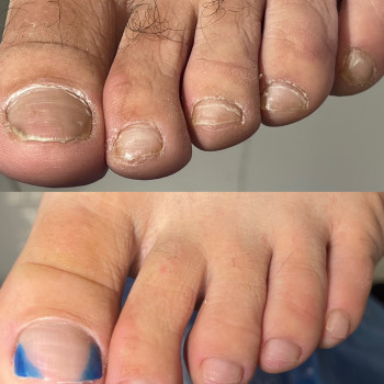 Проблемні нігті на ногах. Подолог у Мукачево.
 #подологМукачево #медичнийпедикюр #нігті