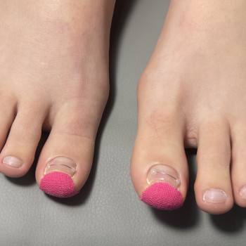 Проблемні нігті на ногах .
Професійна обробка +корекційна система Подолог у Мукачево.
   