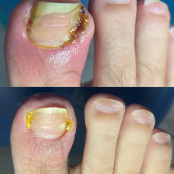 Врослий ніготь, запалення та біль. Подологічна обробка в Мукачево.
   