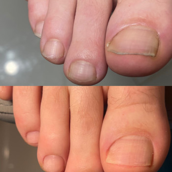 Чоловічий педикюр,професійна обробка нігтів і стоп 
   