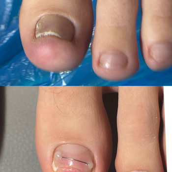 Титанова нитка,корекційна система яка допомагає відростити здорові нігті
   