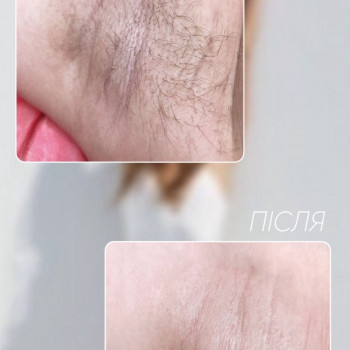 Результат процедури лазерної епіляції