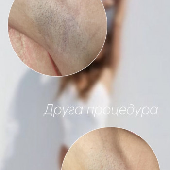 Результат процедури лазерної епіляції