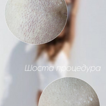 Результат процедури лазерної епіляції