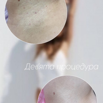 Результат процедури лазерної епіляції