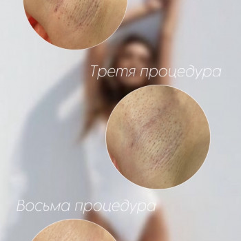 Результат процедури лазерної епіляції