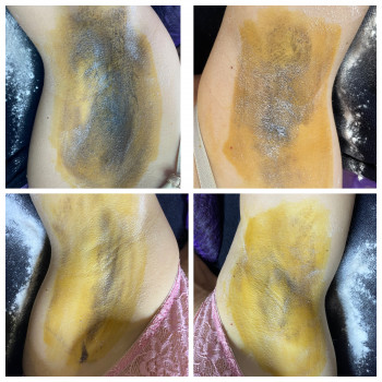 Гіпергідроз ботокс