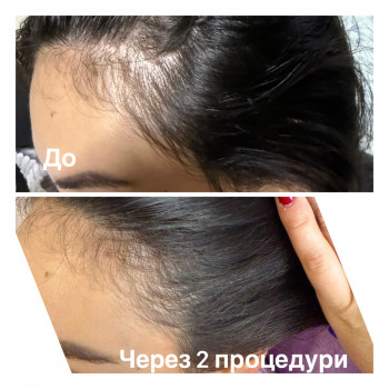 Мезотерапія волося