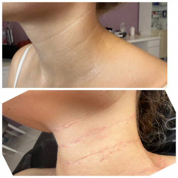 Заповнення зморшок шиї