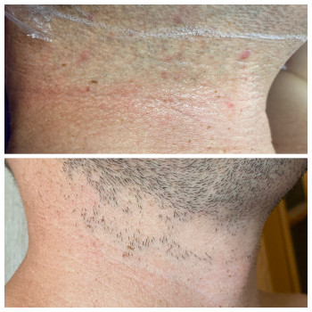 Лазерна епіляція