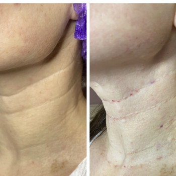 Заповнення кілець Венери