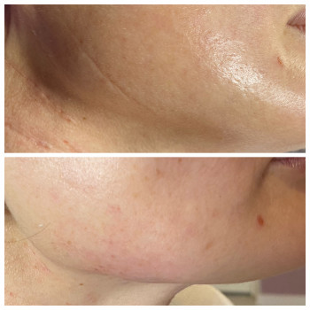 Заповнення дермальних заломів