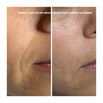 Заповнення носогубної складки та дермальних заломів