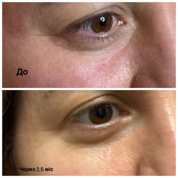 Джувілук периорбітальної зони ( носослізна борозна)