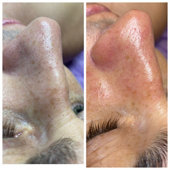 Чистка+ пілінг