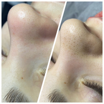 Чистка+ пілінг