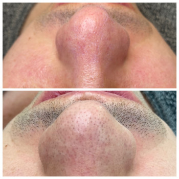 Чистка+ пілінг