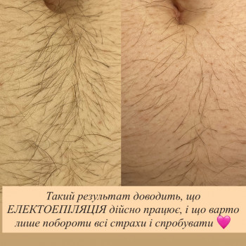 Електроепіляція
                    Мастер шугаринга Яна Полтава
