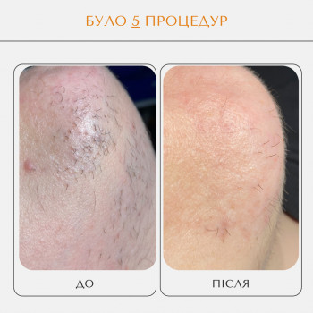 Електроепіляція
                    Мастер шугаринга Яна Полтава