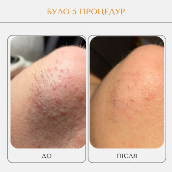 Електроепіляція
                    Мастер шугаринга Яна Полтава