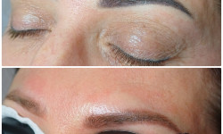 Удаление татуажа,перманента,тату на неодимовом,пикосекундном лазере Косметолог Інга Хмельницький