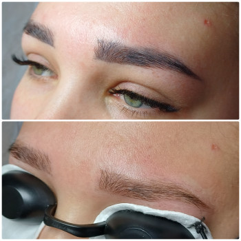 Після 1ої процедури видалення