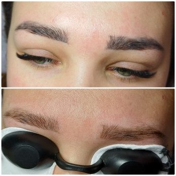 Після 1ої процедури видалення