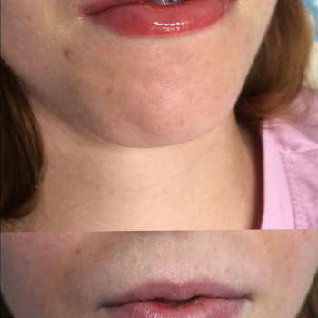 Первинна коррекцвя, додали 0,55 мл філлеру