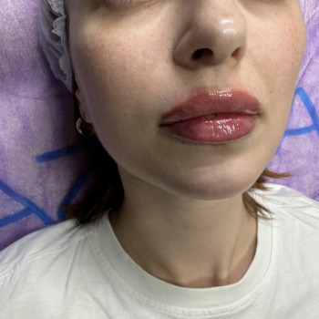 збільшення губ, контурна пластика губ, збільшення губ