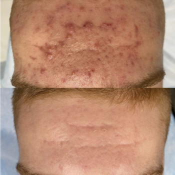 Лікування акне , вийшли в ремісію через 6 міс.