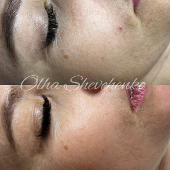  #мезопілінг
 #доглядзаобличчям