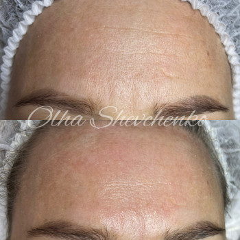  #мезопілінг
 #доглядзаобличчям