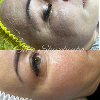  #мезопілінг
 #доглядзаобличчям