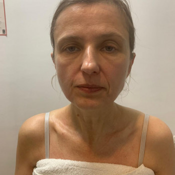 Після шостого масажа обличчя