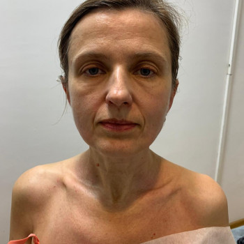 Після третього масажа обличчя