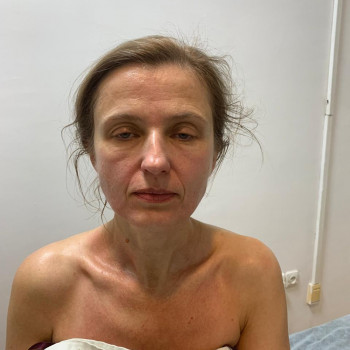 Після другого масажа