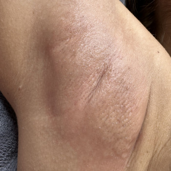 Електро пахви
Фото одразу після процедури