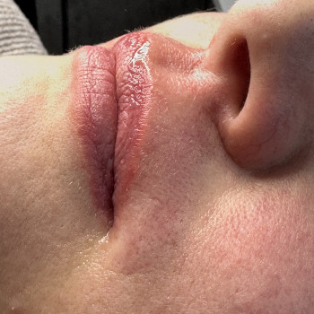 Електро вусики
Фото одразу після процедури