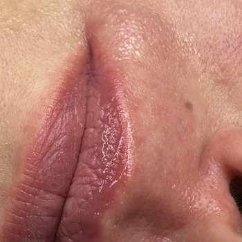 Електро вусики
Фото одразу після процедури